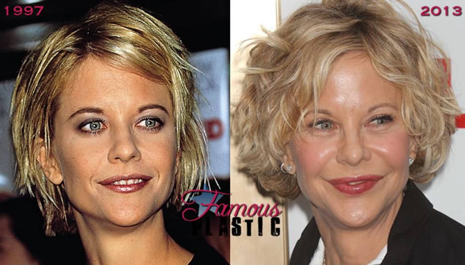 Meg Ryan’s Before and After Plastic Surgery Photos Should